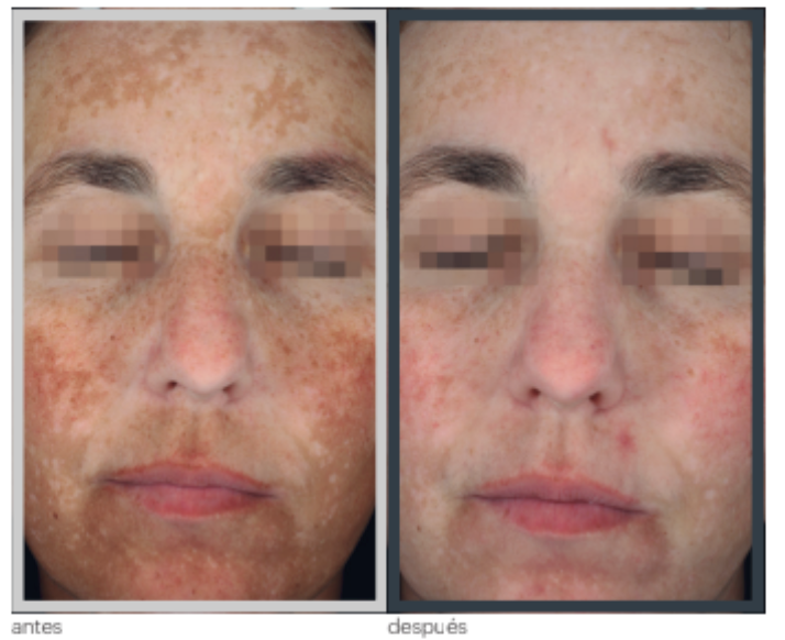 Melasma